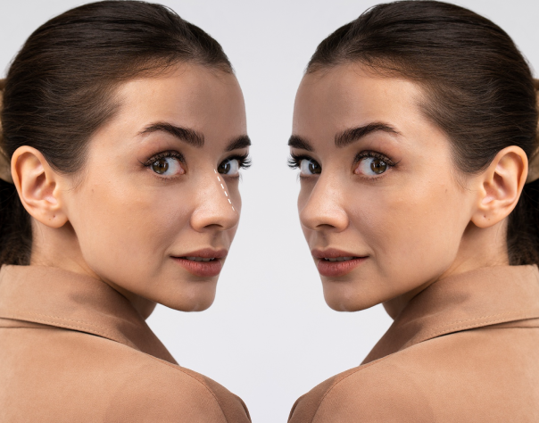 Surgical-Rhinoplasty-img