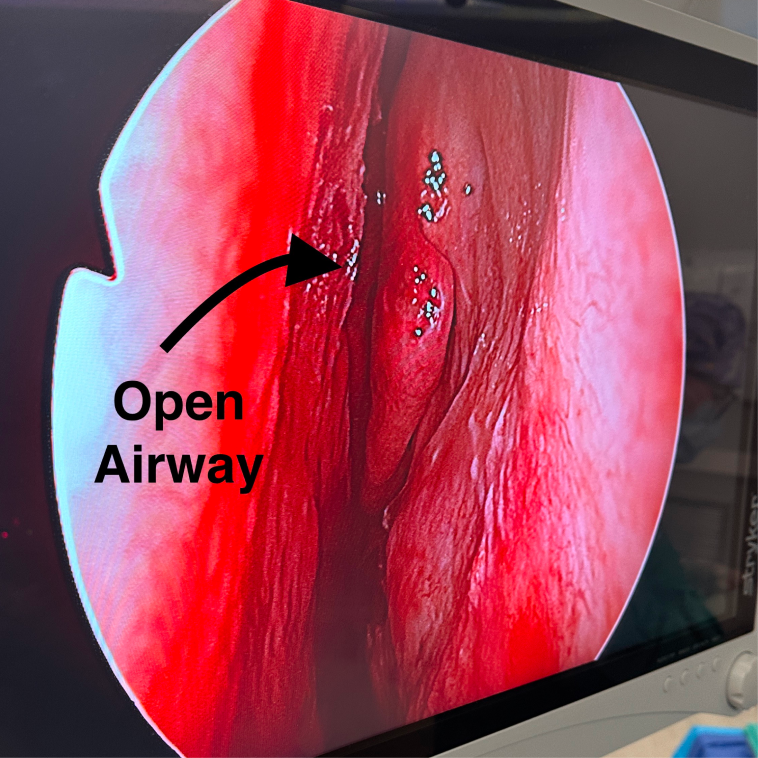 open-airway